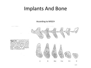 Implants And Bone
104
According to MISCH
 