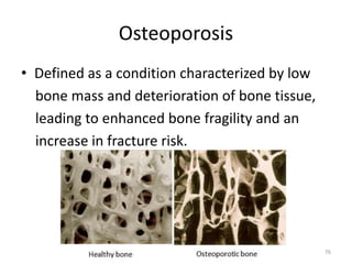 Osteoporosis
• Defined as a condition characterized by low
bone mass and deterioration of bone tissue,
leading to enhanced bone fragility and an
increase in fracture risk.
76
 