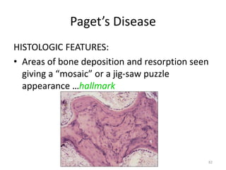 Paget’s Disease
HISTOLOGIC FEATURES:
• Areas of bone deposition and resorption seen
giving a “mosaic” or a jig-saw puzzle
appearance …hallmark
82
 