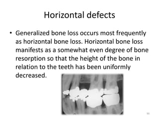 Horizontal defects
• Generalized bone loss occurs most frequently
as horizontal bone loss. Horizontal bone loss
manifests as a somewhat even degree of bone
resorption so that the height of the bone in
relation to the teeth has been uniformly
decreased.
90
 