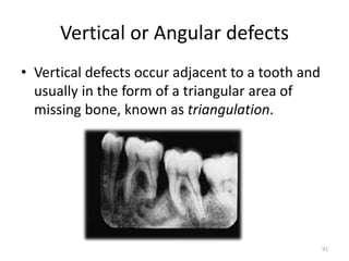 Vertical or Angular defects
• Vertical defects occur adjacent to a tooth and
usually in the form of a triangular area of
missing bone, known as triangulation.
91
 