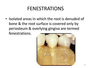 FENESTRATIONS
• Isolated areas in which the root is denuded of
bone & the root surface is covered only by
periosteum & overlying gingiva are termed
fenestrations.
92
 