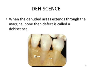 DEHISCENCE
• When the denuded areas extends through the
marginal bone then defect is called a
dehiscence.
93
 