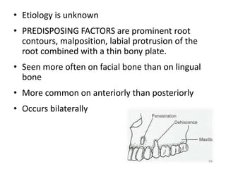 • Etiology is unknown
• PREDISPOSING FACTORS are prominent root
contours, malposition, labial protrusion of the
root combined with a thin bony plate.
• Seen more often on facial bone than on lingual
bone
• More common on anteriorly than posteriorly
• Occurs bilaterally
94
 