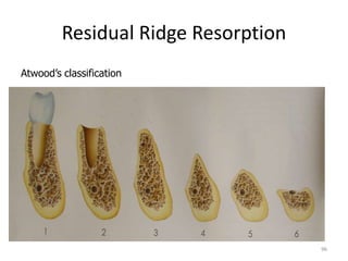 Residual Ridge Resorption
Atwood’s classification
96
 