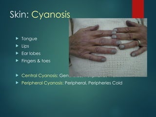 Skin: Cyanosis
 Tongue
 Lips
 Ear lobes
 Fingers & toes
 Central Cyanosis: Generalize, Peripheries Warm
 Peripheral Cyanosis: Peripheral, Peripheries Cold
 