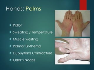 Hands: Palms
 Pallor
 Sweating / Temperature
 Muscle wasting
 Palmar Erythema
 Dupuyten's Contracture
 Osler’s Nodes
 