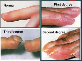 Normal First degree
Second degree
Third degree
 