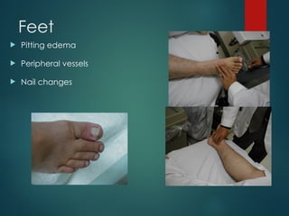 Feet
 Pitting edema
 Peripheral vessels
 Nail changes
 