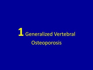 1Generalized Vertebral
Osteoporosis
 