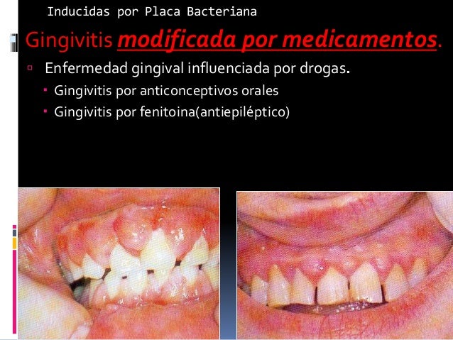 gingivitis