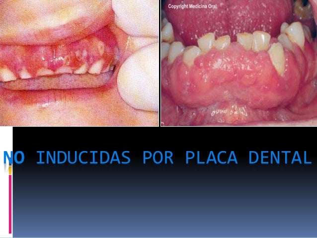 gingivitis