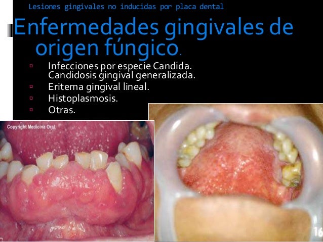 gingivitis
