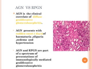 Rpgn Patterns 1 glomerular disease & anatomy pysiology of kideny | PPT
