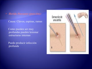 Herida Punzante (punción): Causa: Clavos, espinas, ramas Como pueden ser muy profundas pueden lesionar estructuras internas Puede producir infección profunda 
