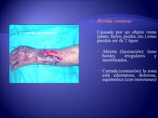 Herida contusa:   Causado por un objeto romo (plato, fierro, piedra, etc.) estas pueden ser de 2 tipos: Abierta (laceración): tiene bordes irregulares y mortificados.  Cerrada (contusión): la zona está edematosa, dolorosa, equimótica (con moretones) H. CONTUSA EN ANTEBRAZO 