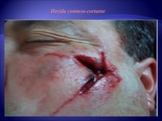 Herida contusa-cortante 
