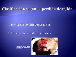I. Herida sin perdida de sustancia II. Herida con perdida de sustancia                                                                     FIGURA 1. Herida facial contusa con pérdida de sustancia. 