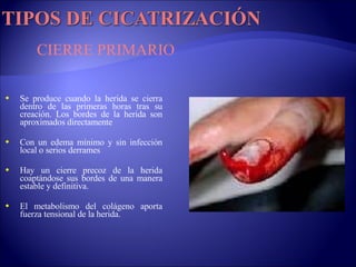 Se produce cuando la herida se cierra dentro de las primeras horas tras su creación. Los bordes de la herida son aproximados directamente Con un edema mínimo y sin infección local o serios derrames Hay un cierre precoz de la herida coaptándose sus bordes de una manera estable y definitiva.  El metabolismo del colágeno aporta fuerza tensional de la herida.  CIERRE PRIMARIO 