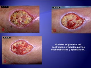 El cierre se produce por contracción producida por los miofibroblastos y epitelización.  