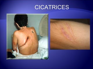 CICATRICES 