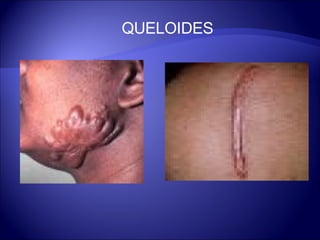 QUELOIDES 