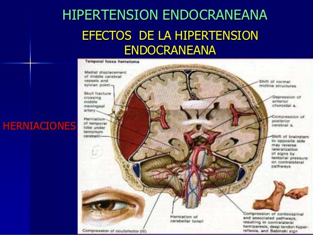 Hipertensión Arterial Sintomas Natural