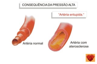 CONSEQUÊNCIADA PRESSÃO ALTA
Artéria normal
“Artéria entupida.“
Artéria com
aterosclerose
 