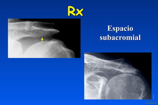 Rx
Espacio
subacromial
 