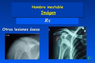 Rx
Otras lesiones óseas
Hombro inestable 
Imágen
 