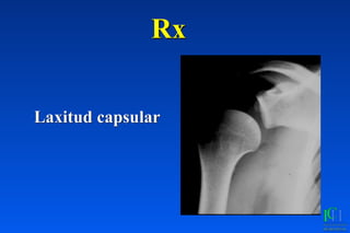 Rx
Laxitud capsular
 
