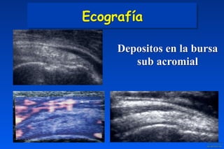Depositos en la bursa
sub acromial
Ecografía
 