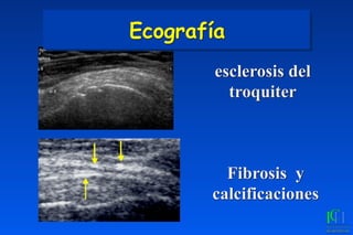 esclerosis del
troquiter
Fibrosis y
calcificaciones
Ecografía
 