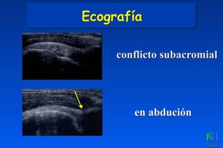 conflicto subacromial
en abdución
Ecografía
 