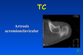 TC
Artrosis
acromionclavicular
 