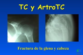 TC y ArtroTC
Fractura de la glena y cabeza
 
