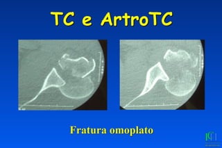 TC e ArtroTC
Fratura omoplato
 