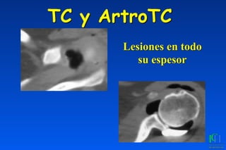 TC y ArtroTC
Lesiones en todo
su espesor
 