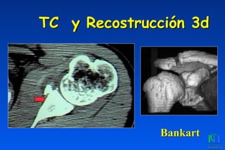 TC y Recostrucción 3d
Bankart
 