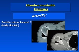 artroTC
Avulsión cabeza humeral !
(HAGL/RHAGL)
Hombro inestable 
Imágenes
 