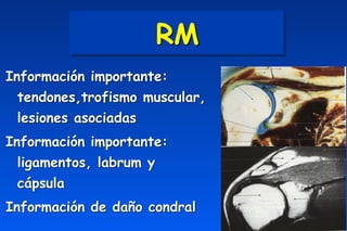RM
Información importante:
tendones,trofismo muscular,
lesiones asociadas
Información importante:
ligamentos, labrum y
cápsula
Información de daño condral
 