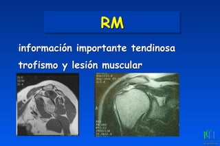 RM
información importante tendinosa
trofismo y lesión muscular
 