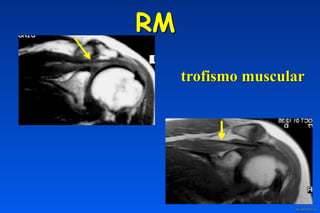 RM
trofismo muscular
 