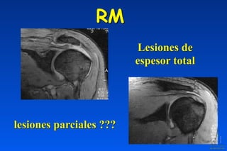 RM
Lesiones de
espesor total
lesiones parciales ???
 