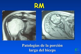 RM
Patologías de la porción
larga del biceps
 