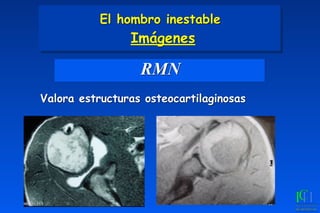 RMN
Valora estructuras osteocartilaginosas
El hombro inestable 
Imágenes
 