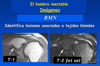 RMN
Identifica lesiones asociadas a tejidos blandos
El hombro inestable 
Imágenes
 