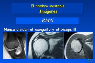 RMN
Nunca olvidar el manguito y el biceps !!!
El hombro inestable 
Imágenes
 