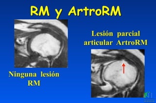 RM y ArtroRM
Ninguna lesión
RM
Lesión parcial
articular ArtroRM
 
