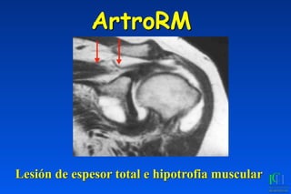 ArtroRM
Lesión de espesor total e hipotrofia muscular
 